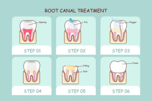 Root Canal Treatment Townsville | North Queensland Family Dental